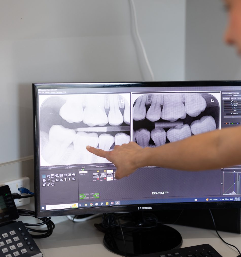Broken Teeth Image